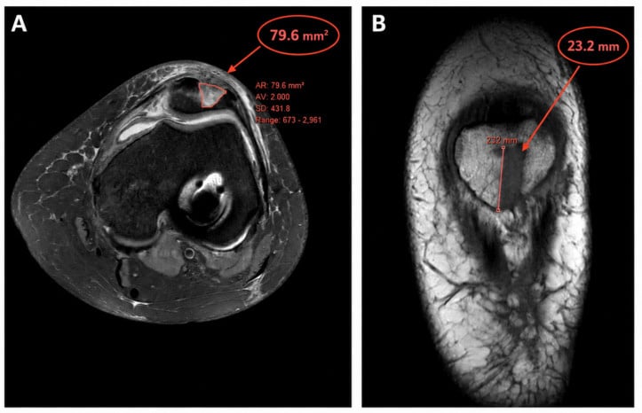 Axial and coronal MRI of the patella four weeks after BTB harvest showing the measured donor-site bone defect