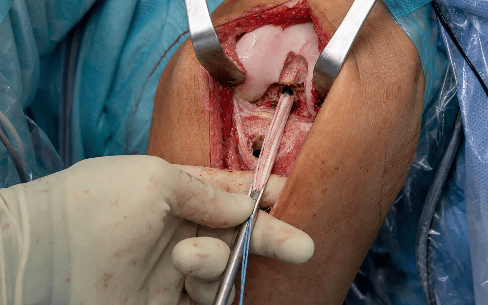 Hamstring autograft harvest