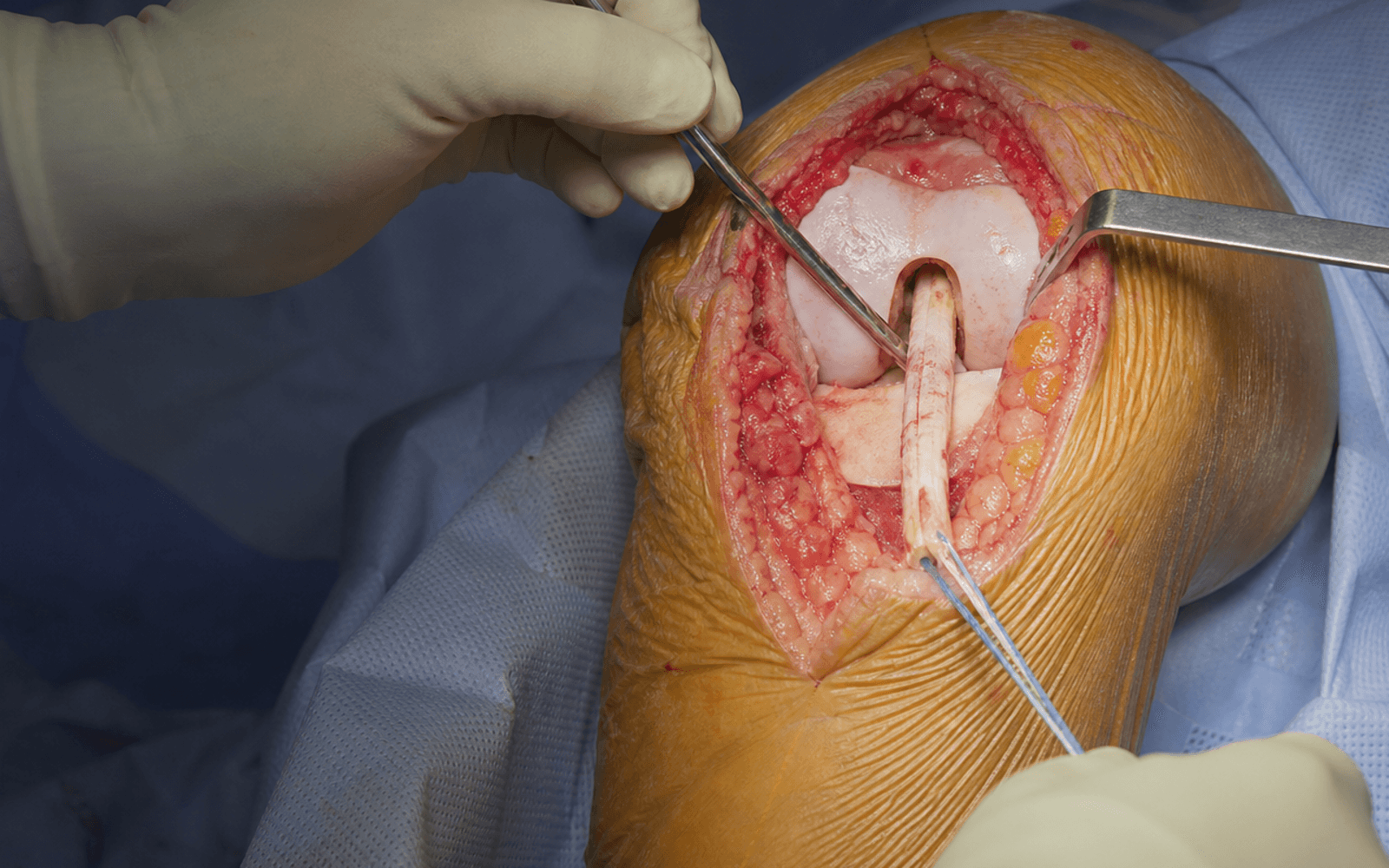 Quadriceps tendon autograft harvest