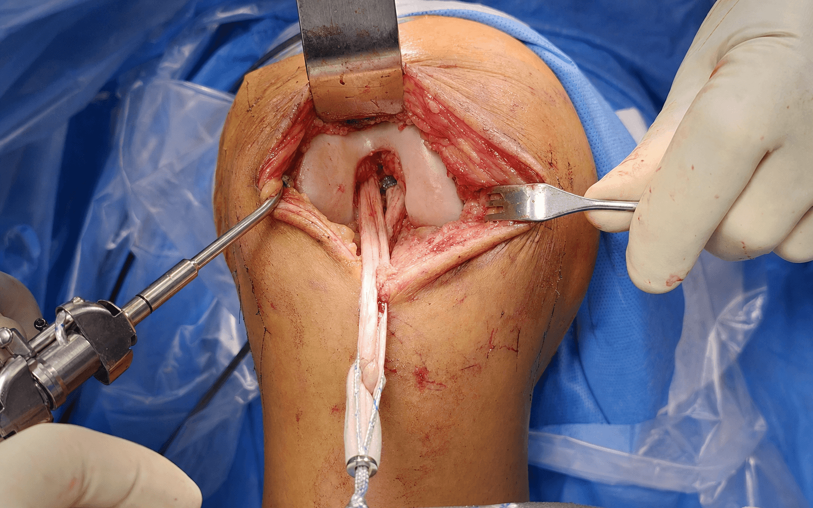 Intra-operative anterior cruciate ligament reconstruction