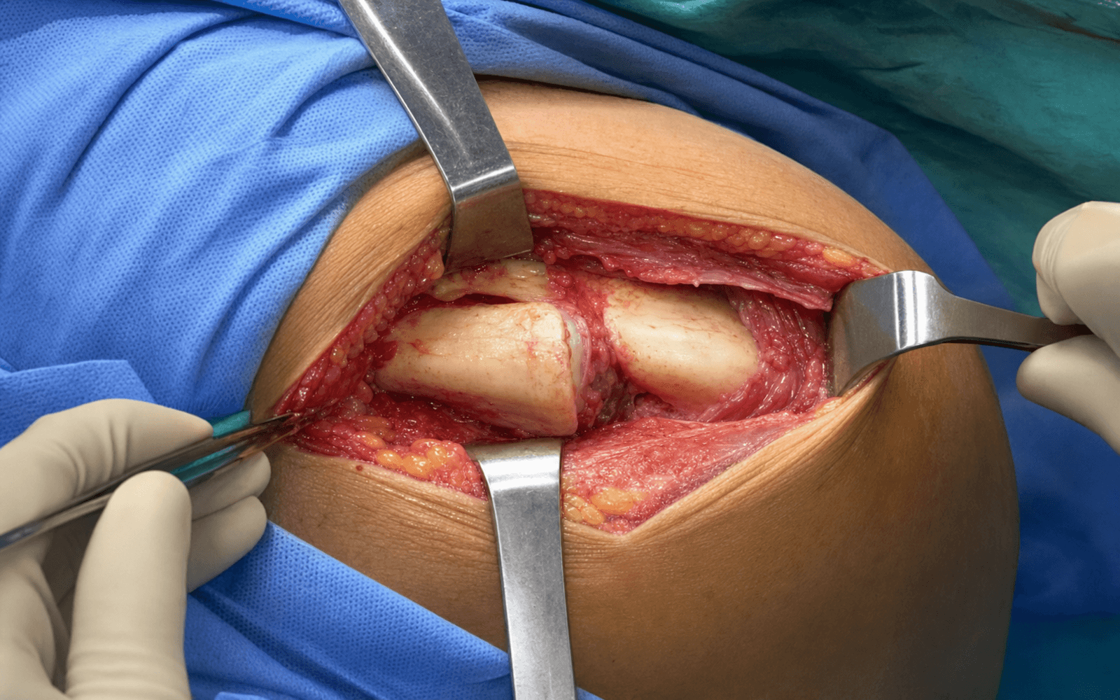 Acromioclavicular joint exposure