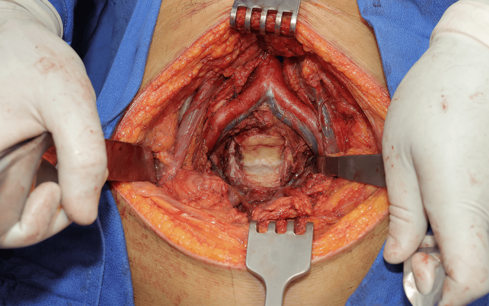 Anterior approach to L5-S1