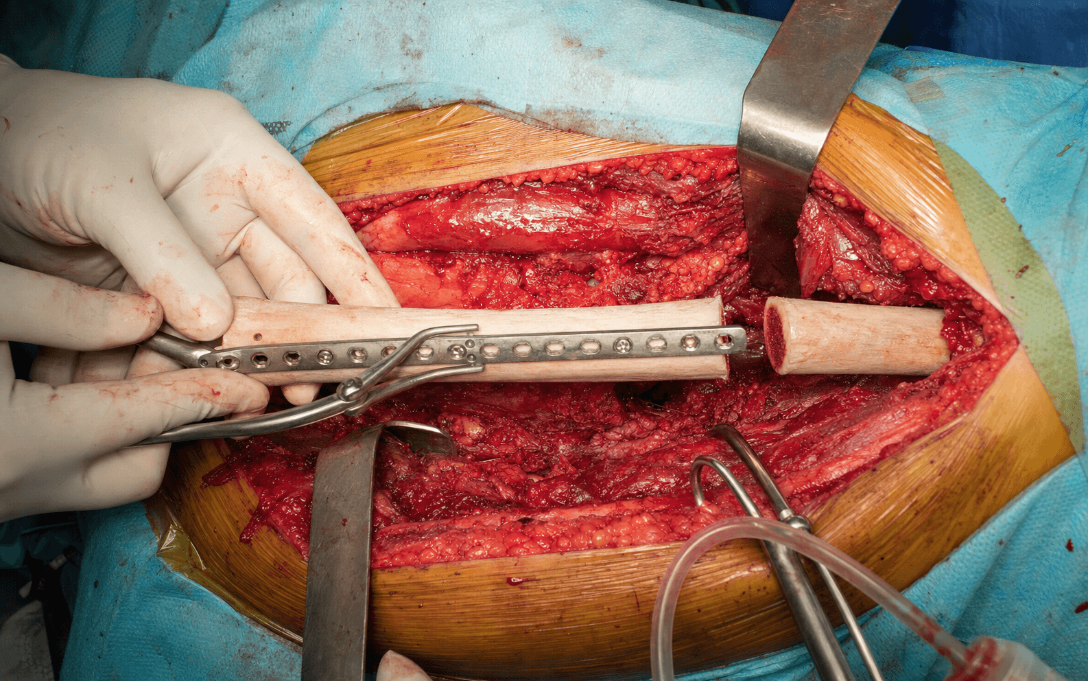 Intercalary allograft reconstruction