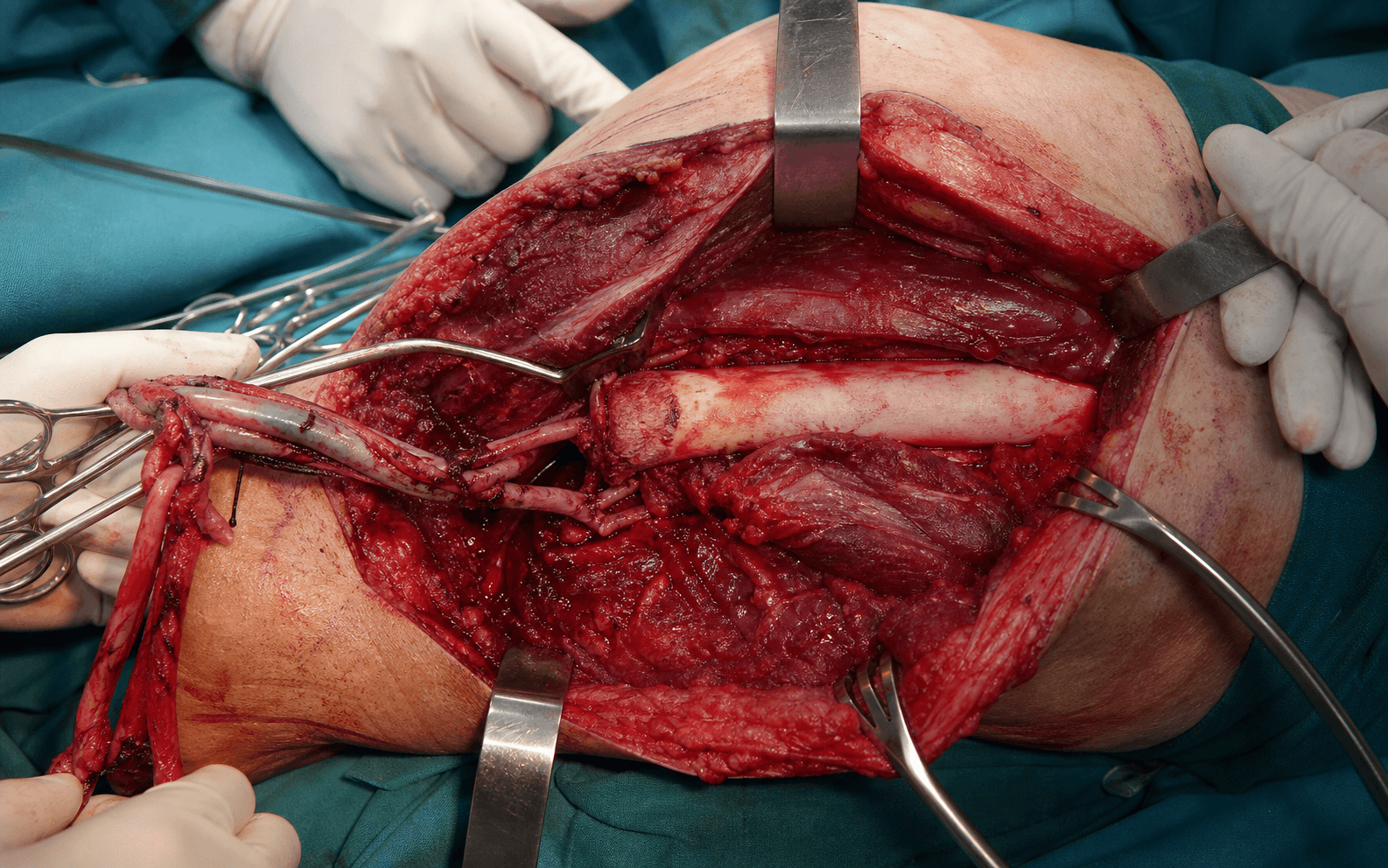 Intra-operative limb dissection during amputation for tumour