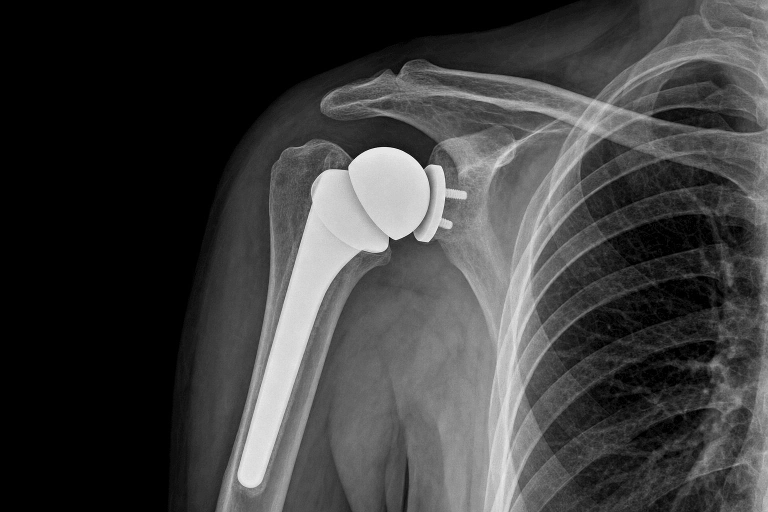 Anatomic total shoulder arthroplasty