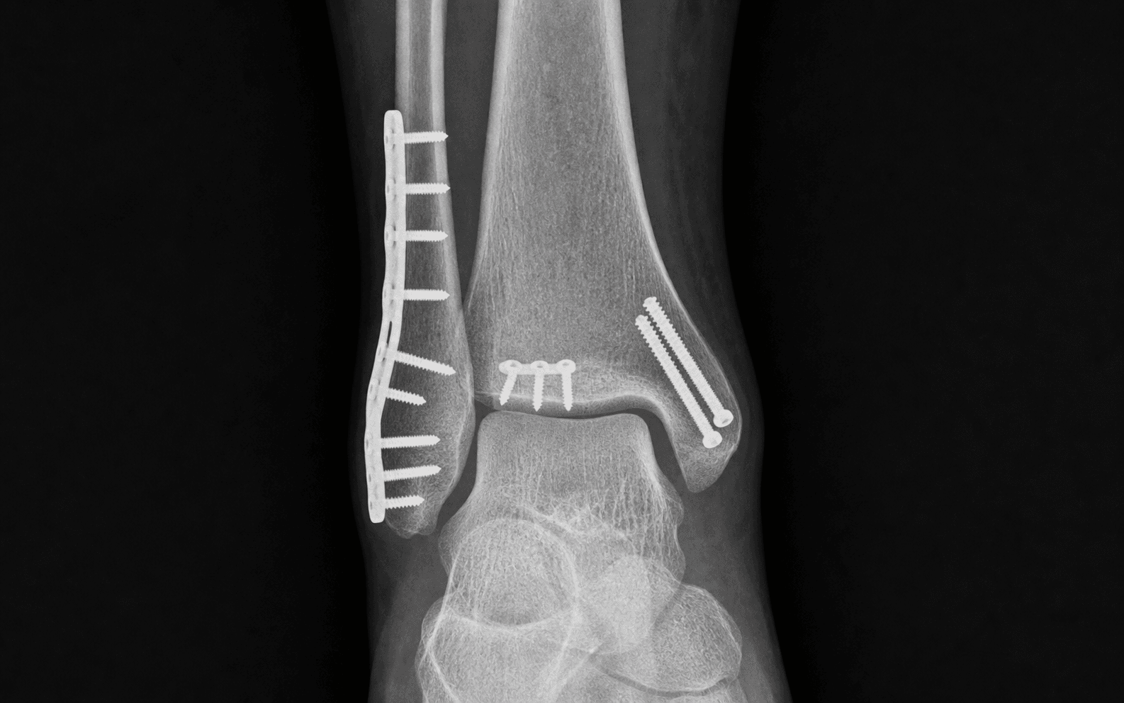 Trimalleolar ankle ORIF