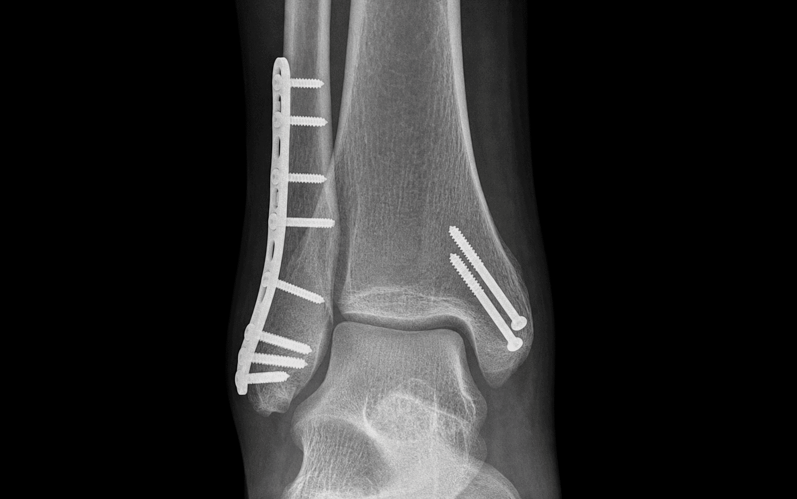 Weber B/C ankle ORIF