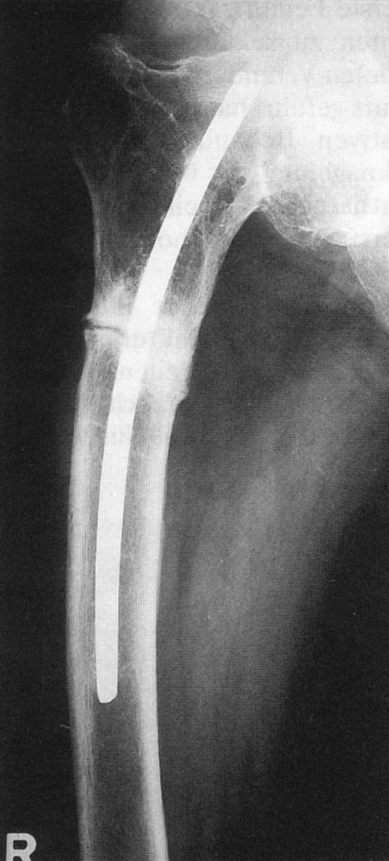 Femoral shaft fracture stabilised with an intramedullary nail