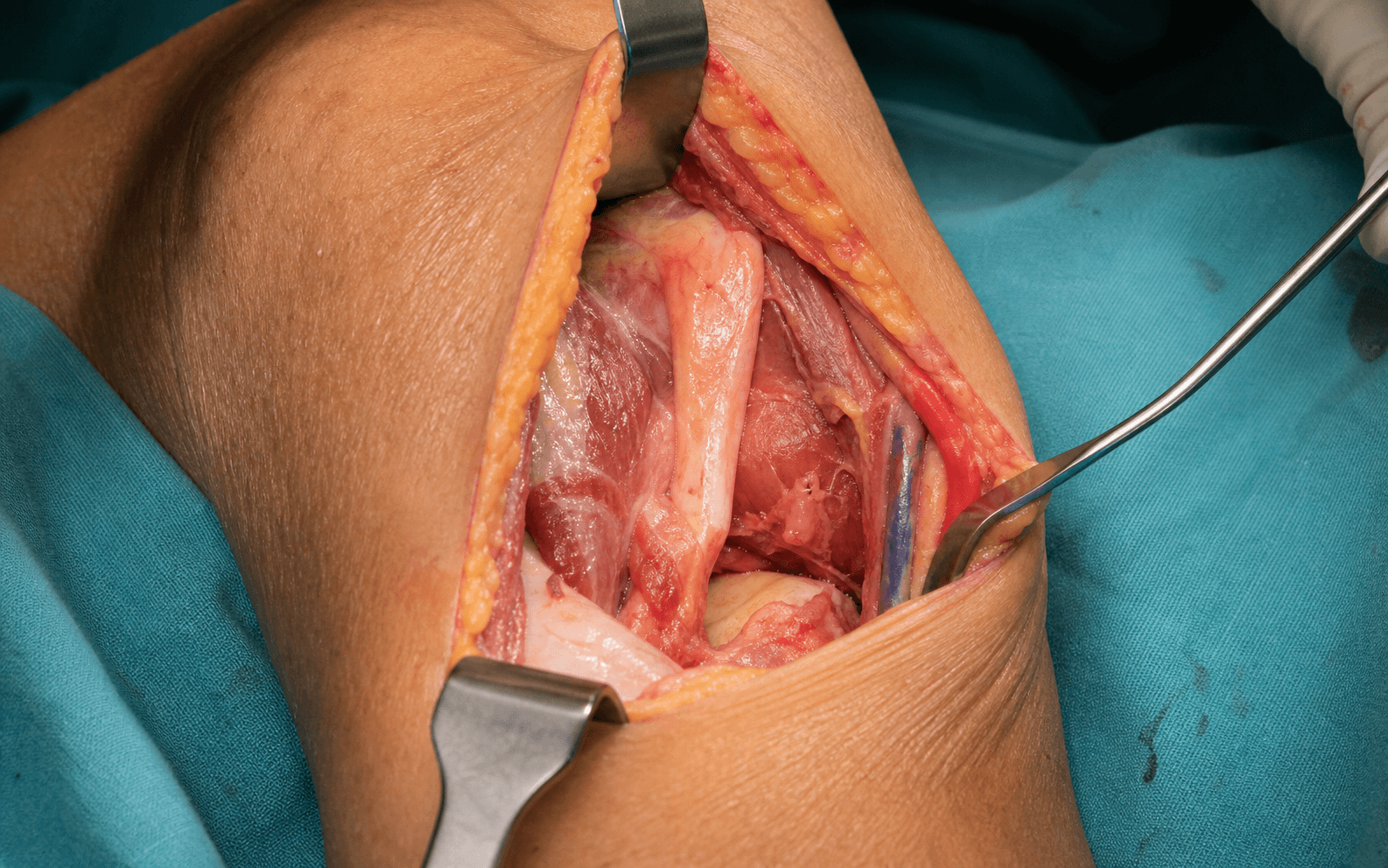 Anterior approach to the elbow