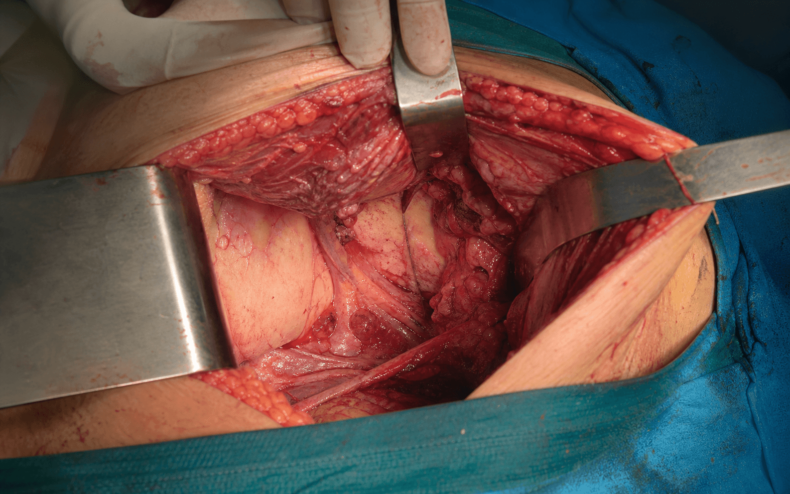 Anterior approach to the SI joint