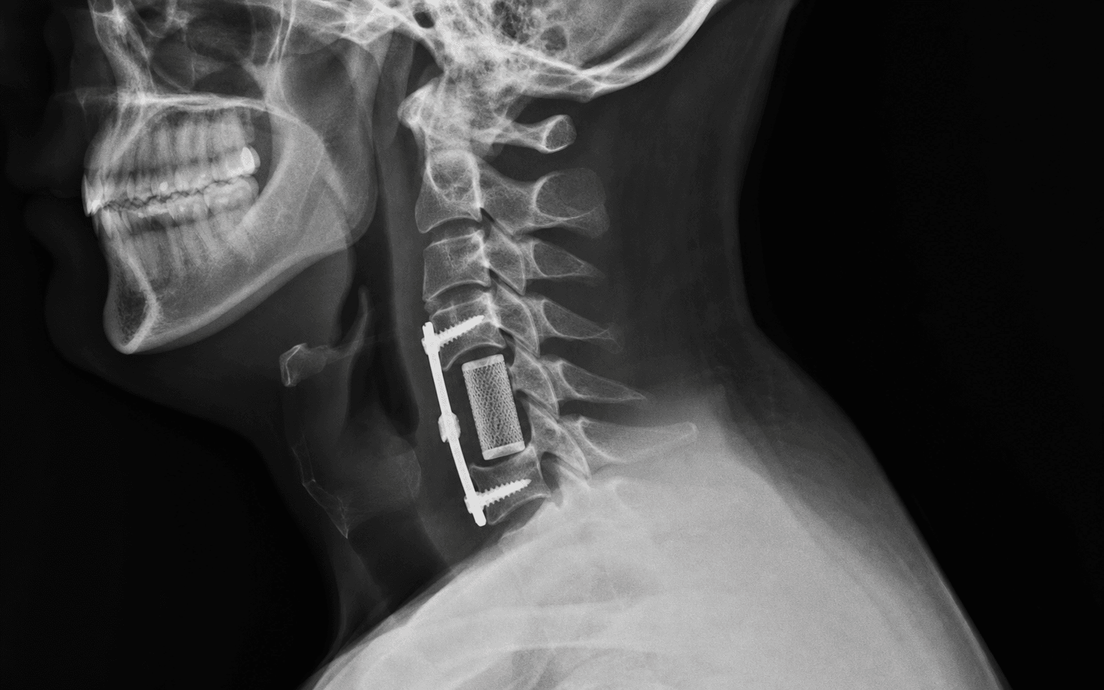 Anterior cervical corpectomy