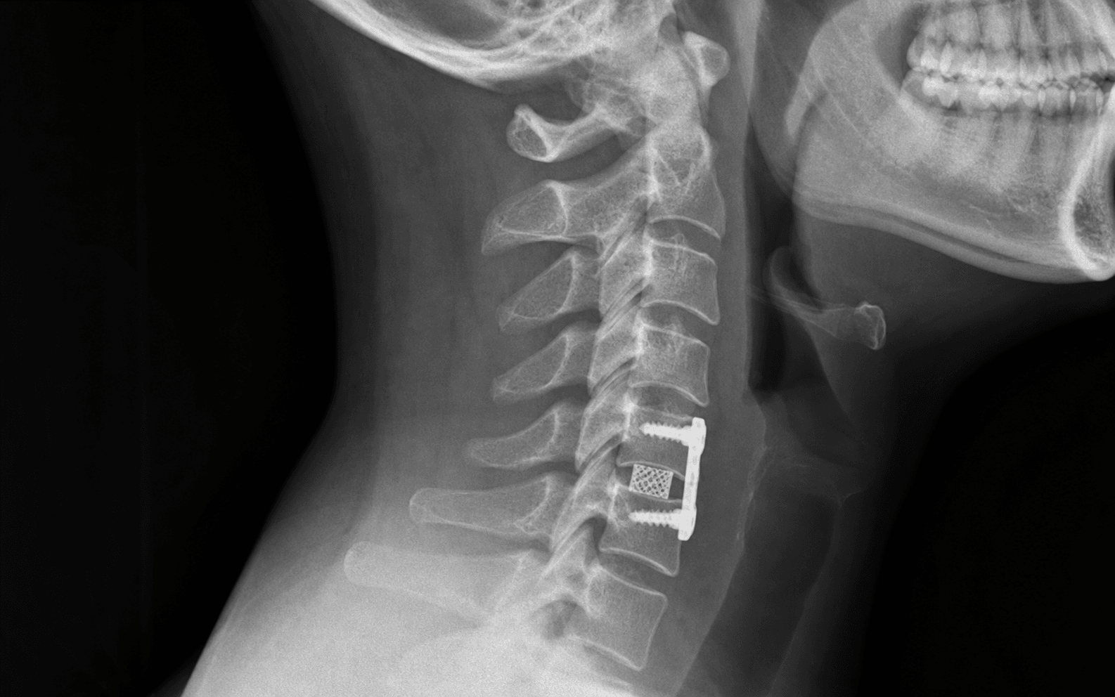 Single-level ACDF