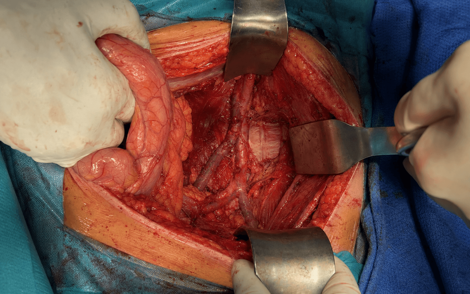 Anterior retroperitoneal lumbar approach