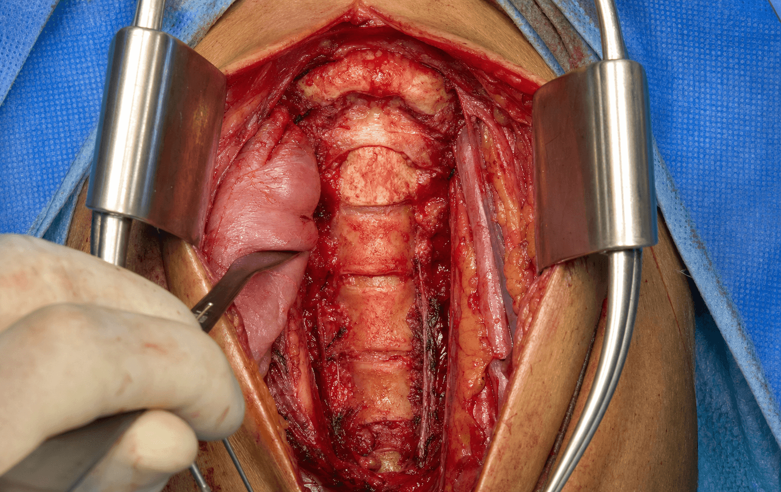 Anterior retropharyngeal cervical approach