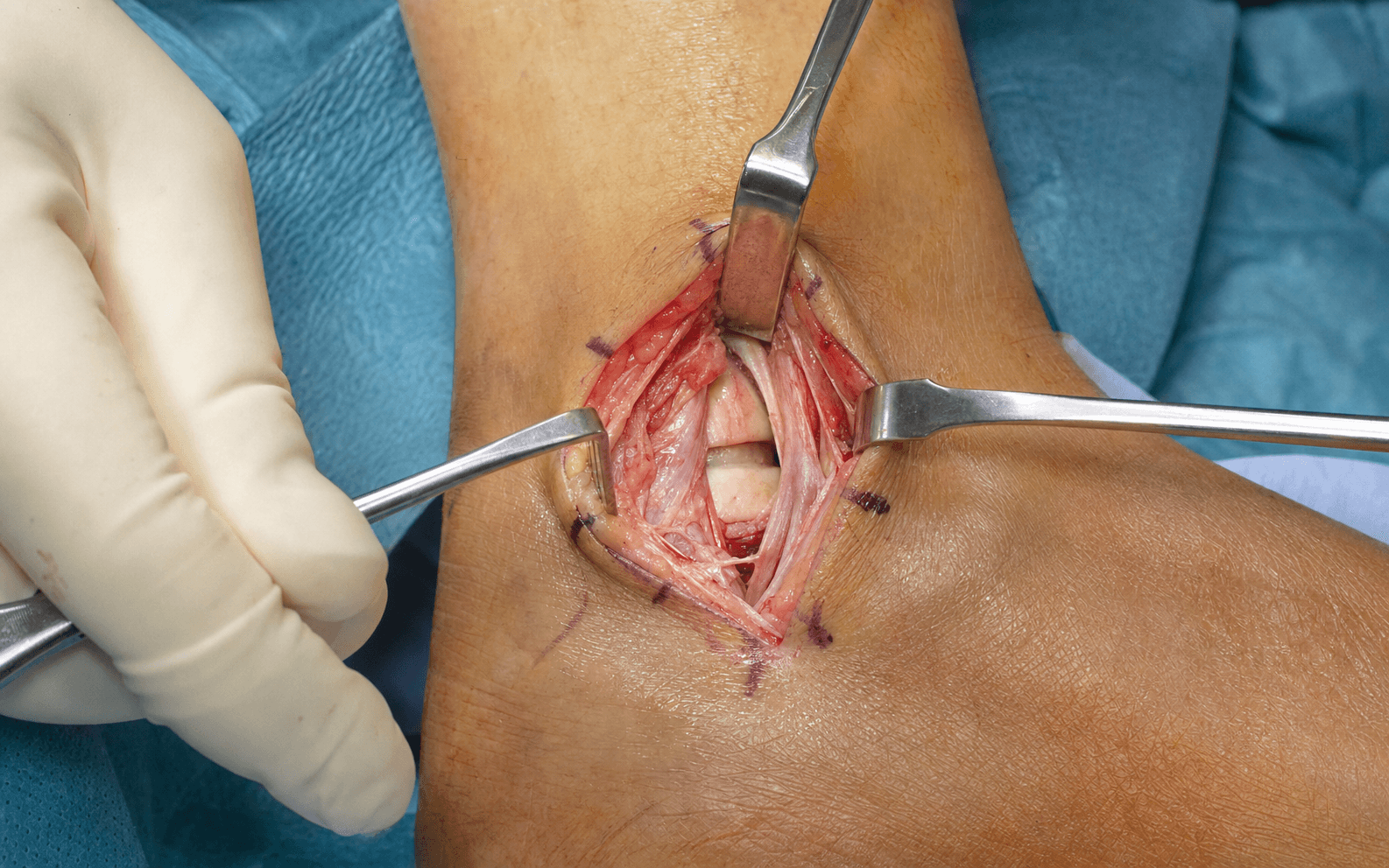 Anterolateral ankle approach