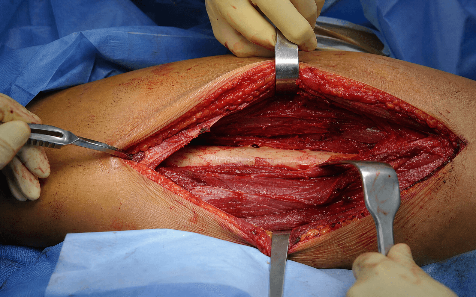 Anterolateral femoral shaft approach