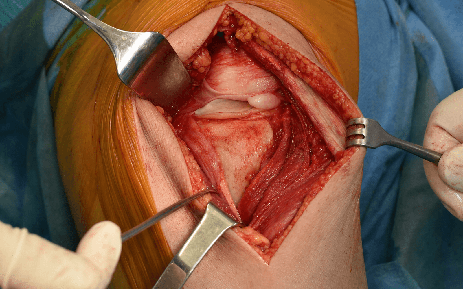 Anterolateral tibial plateau approach