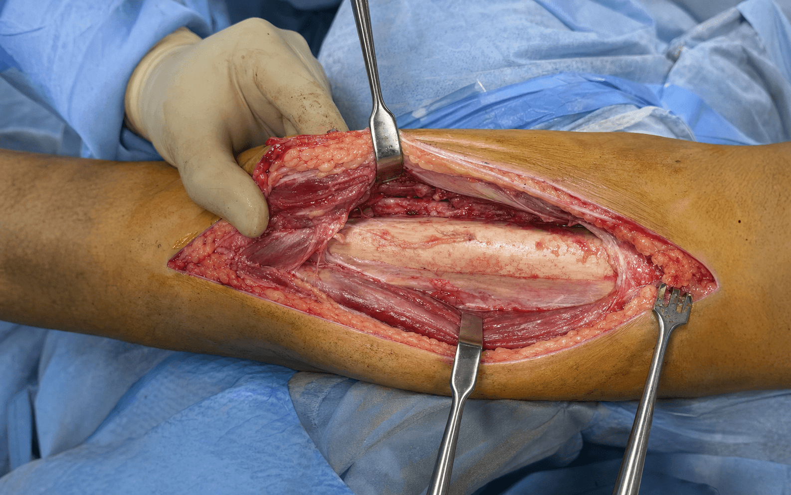 Anteromedial tibial shaft approach