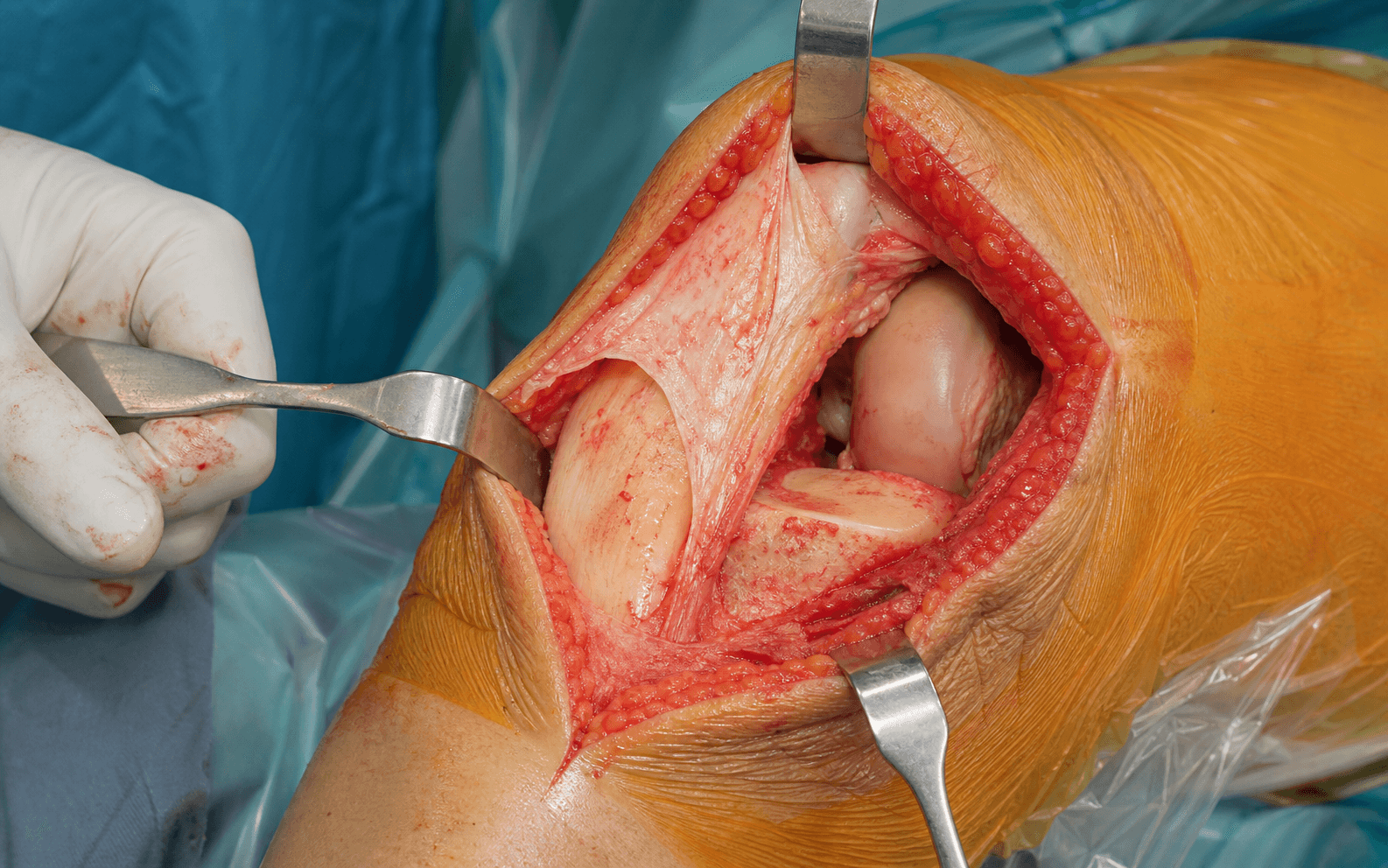 Intra-operative anteromedial approach to the knee