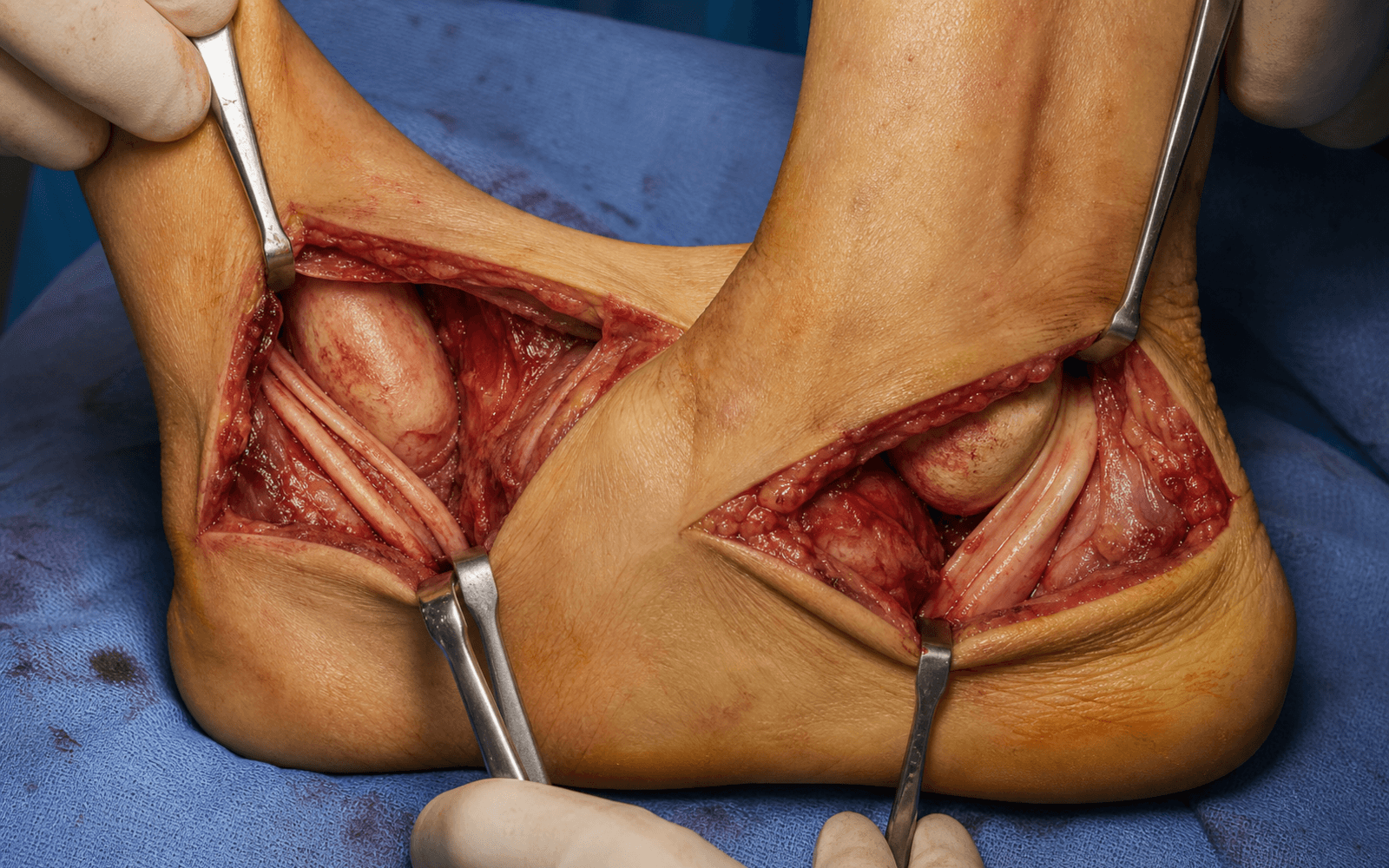 Posterior tibial and peroneal tendon exposure