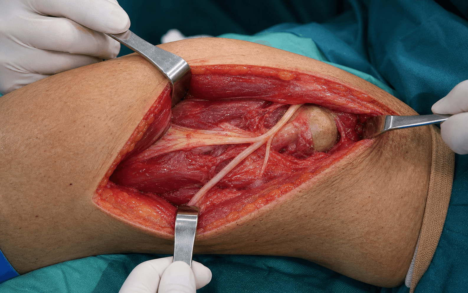Proximal fibula and common peroneal nerve