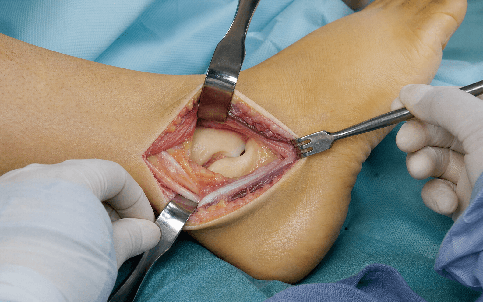 Sinus tarsi subtalar approach