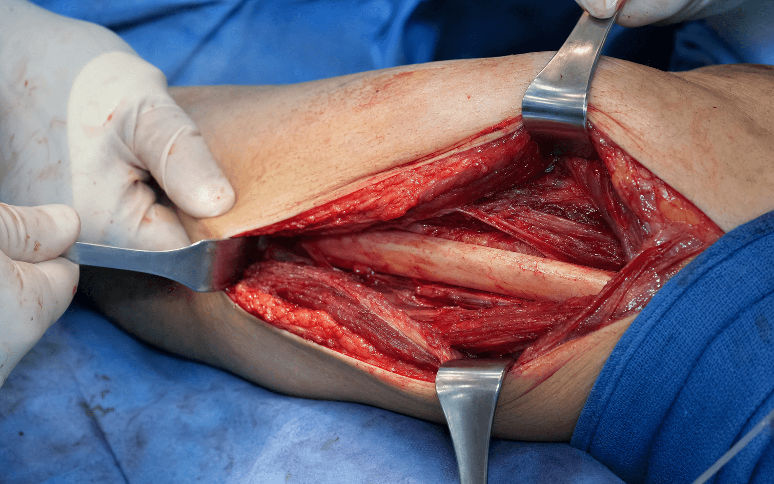 Lateral approach to the fibula