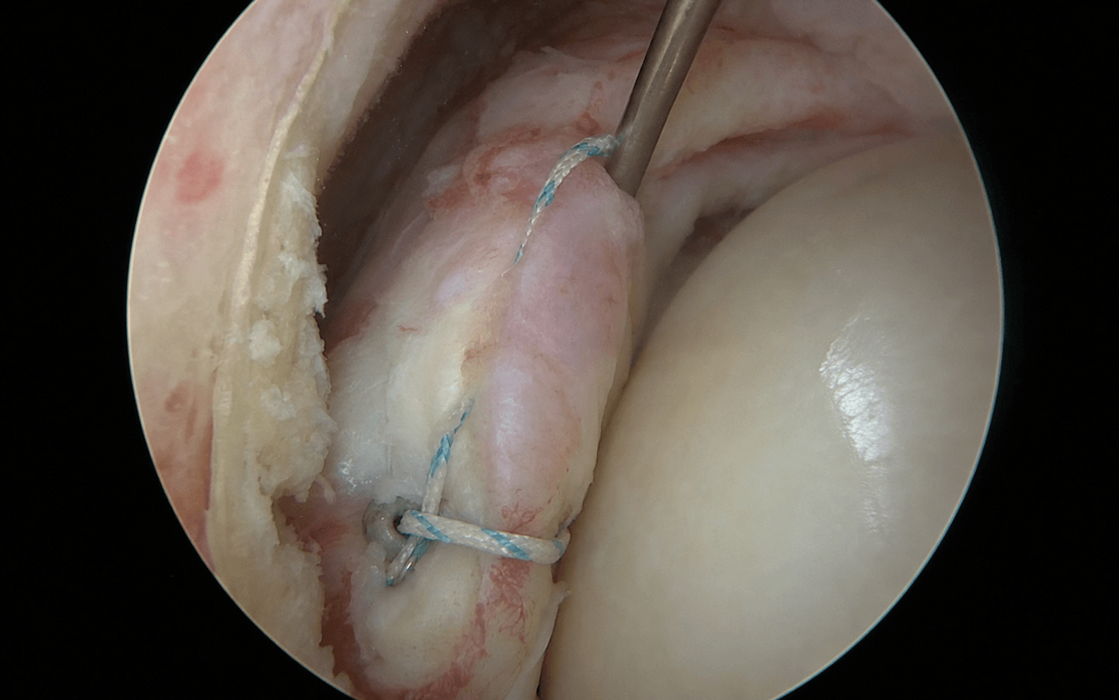 Arthroscopic Bankart repair