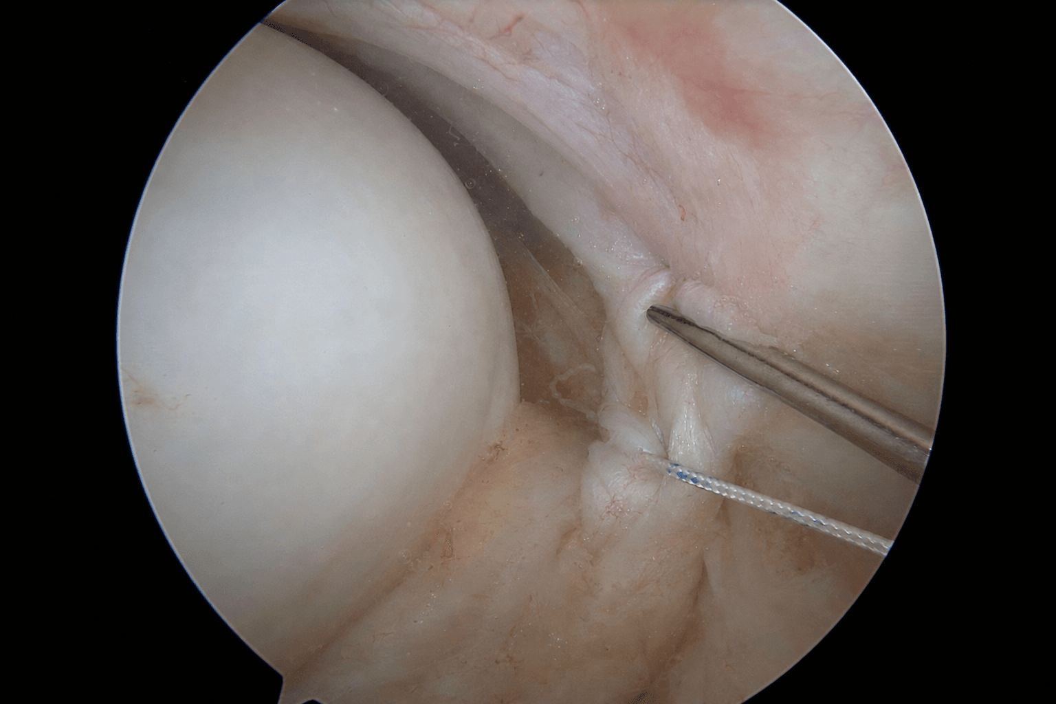 Arthroscopic capsular plication
