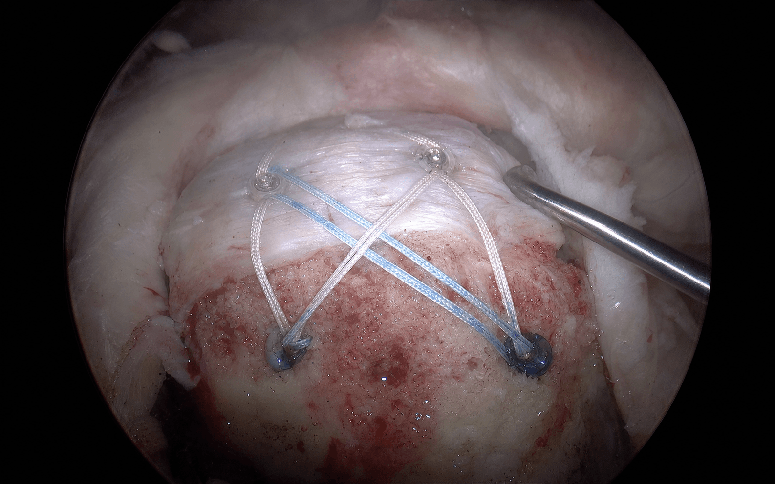 Double-row suture-bridge cuff repair