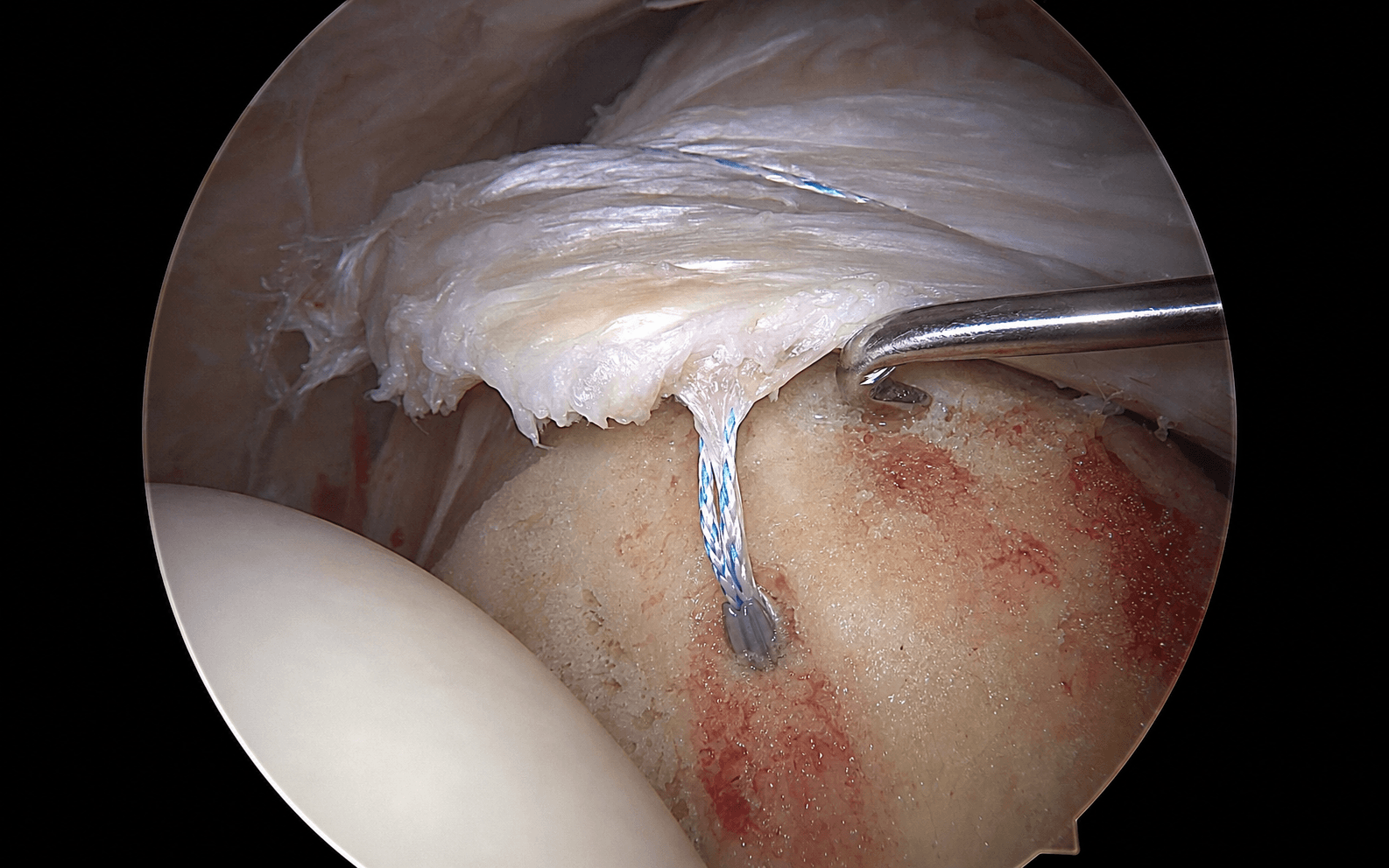 Single-row cuff repair
