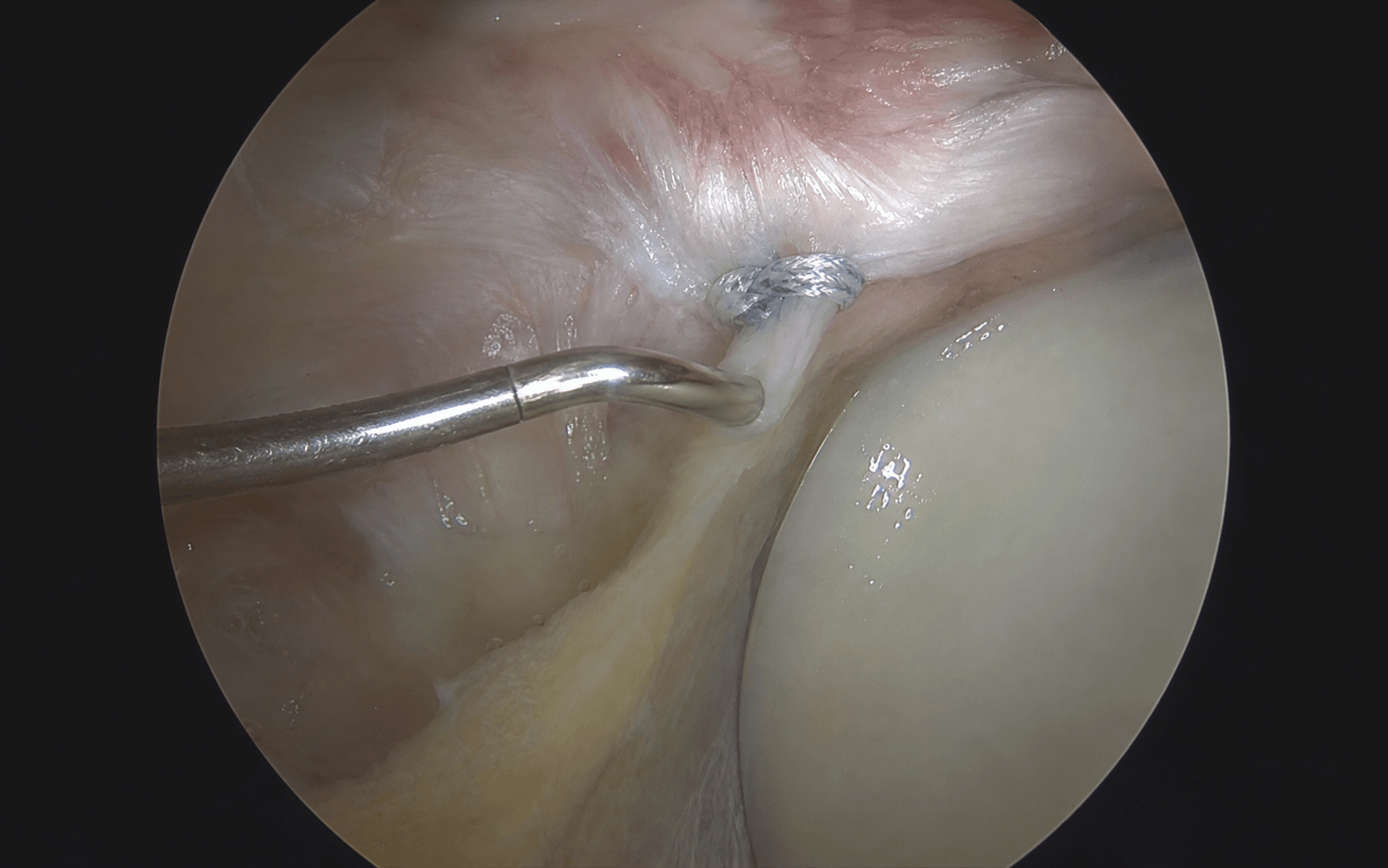 Arthroscopic SLAP repair