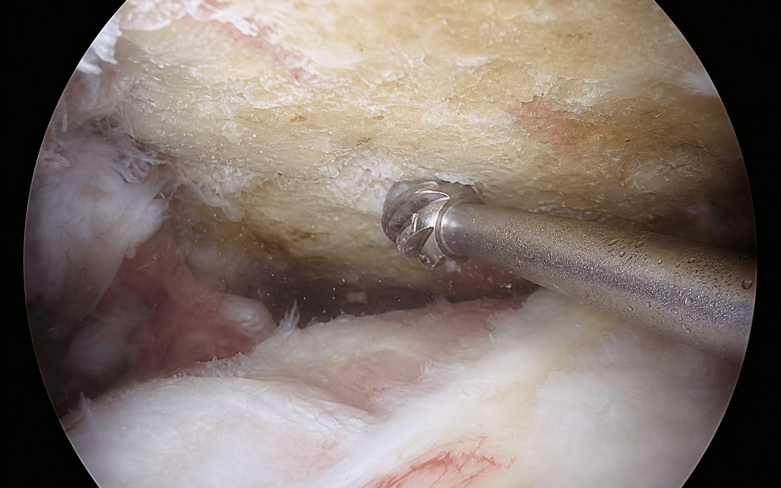 Arthroscopic acromioplasty