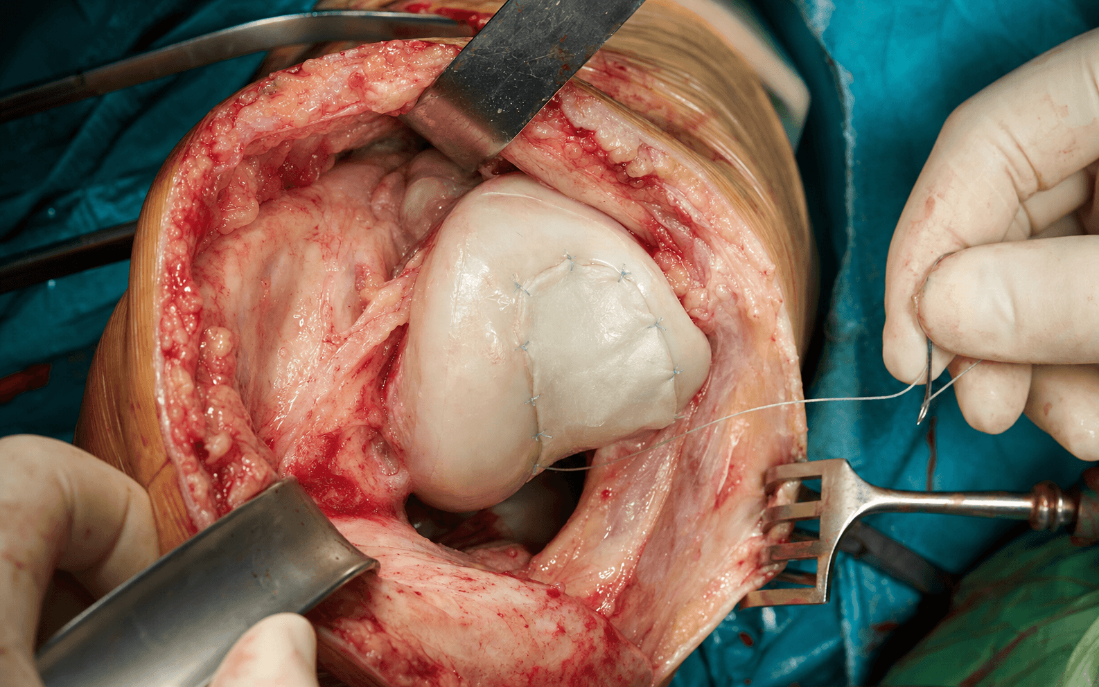 Intra-operative autologous chondrocyte implantation