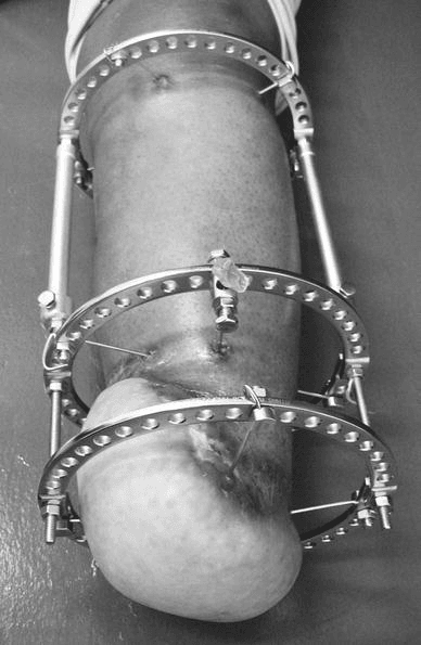 Transtibial stump with calcaneal flap held by Ilizarov circular external fixator at 3 months