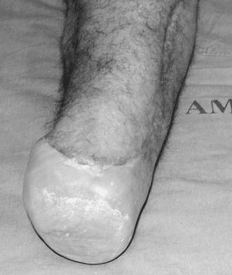 Well-healed transtibial amputation stump at 30 months follow-up