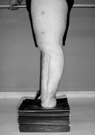 Patient performing full terminal weight-bearing on the transtibial stump at 30 months