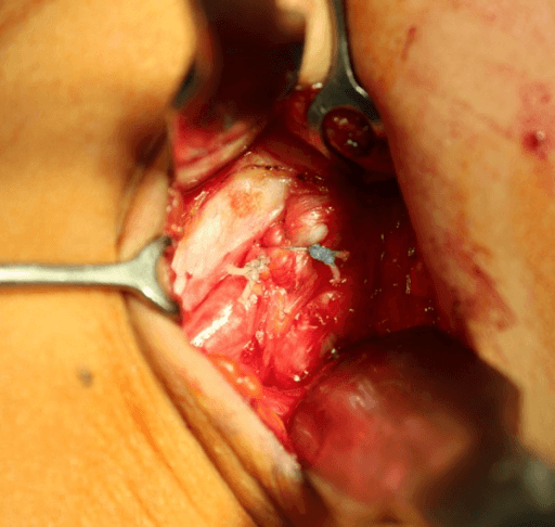 Intraoperative open subpectoral biceps tenodesis showing exposed bicipital groove and tendon