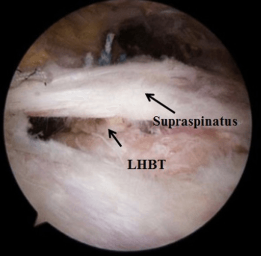 Arthroscopic view showing long head of biceps tendon LHBT and supraspinatus labelled in the glenohumeral joint