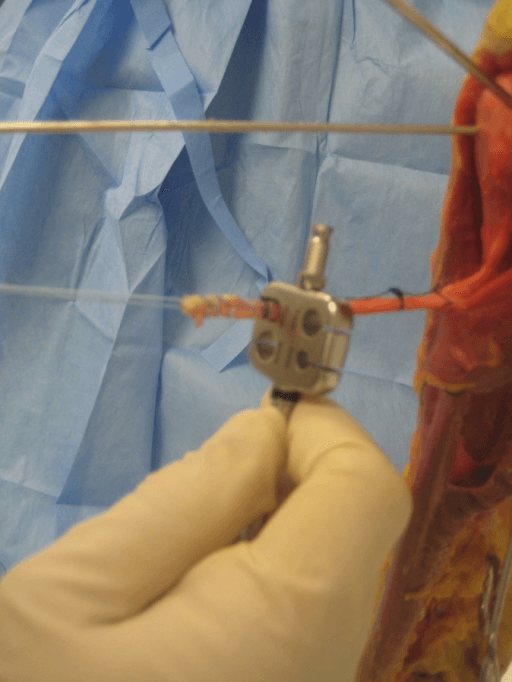 Surgeon holding interference screw with two blue guidewires for biceps tenodesis fixation