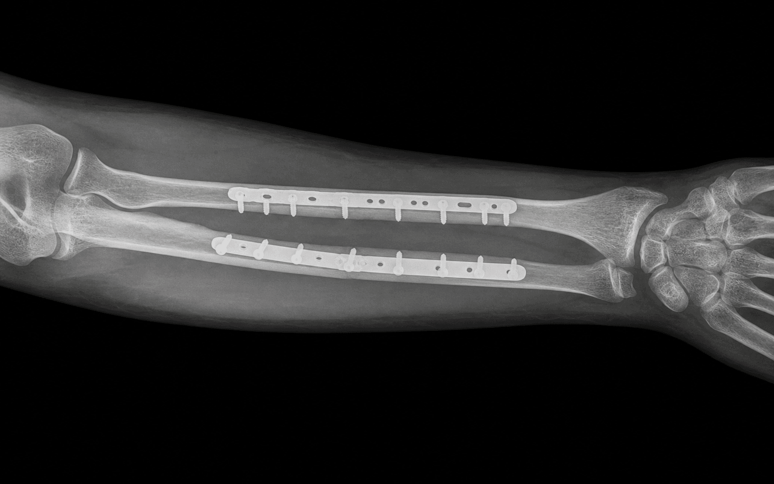 Both-bone forearm ORIF