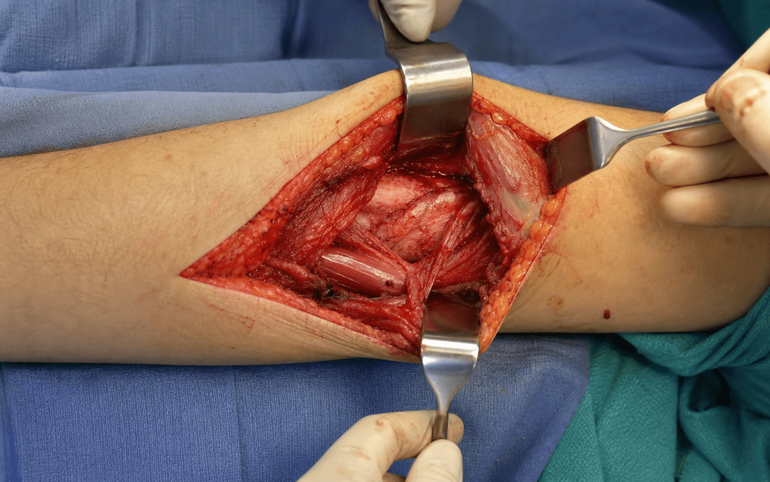 Boyd approach to proximal forearm
