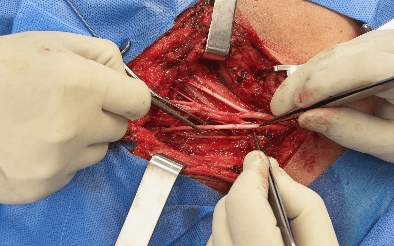 Brachial plexus exploration