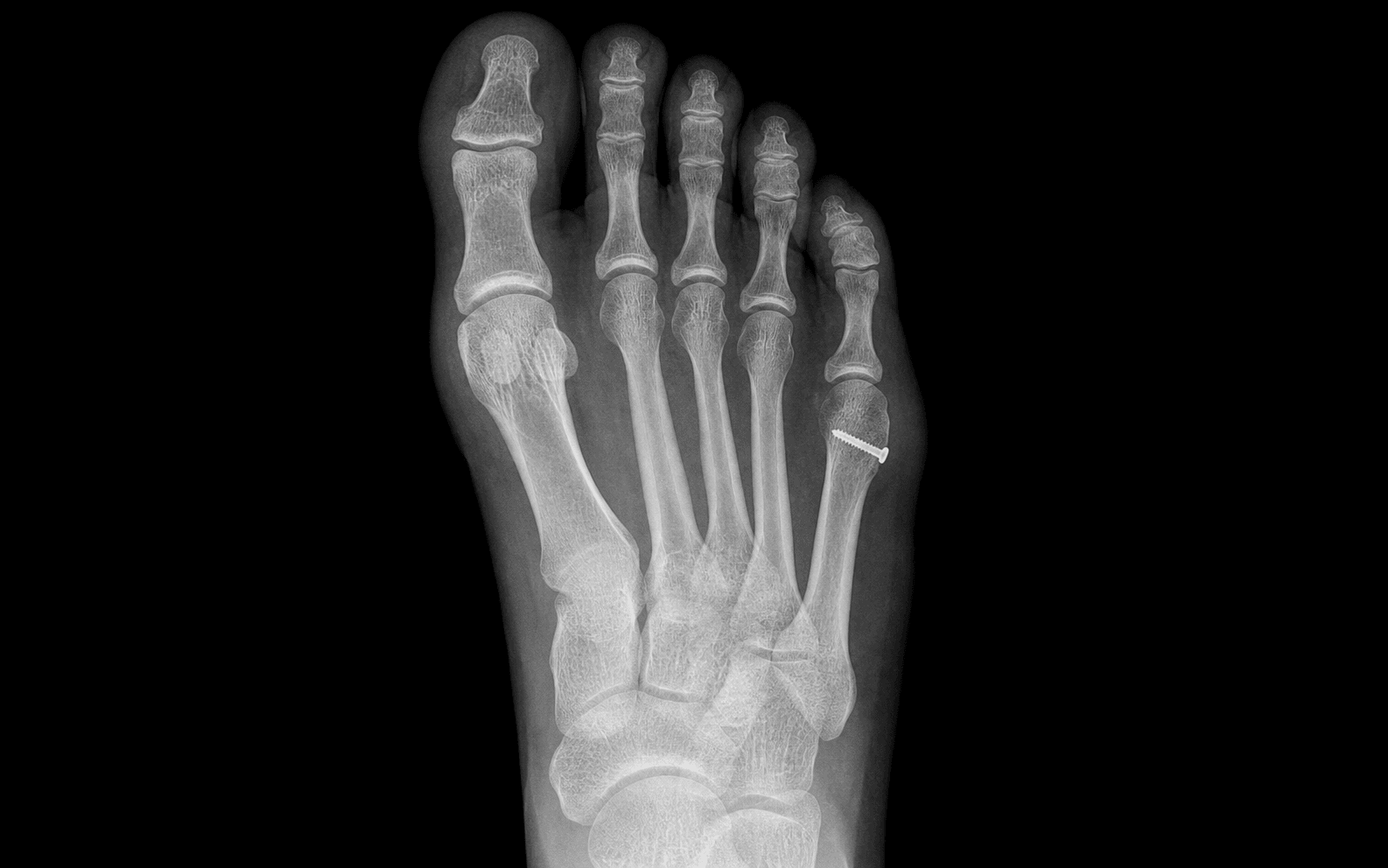 Bunionette fifth metatarsal osteotomy
