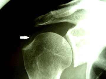 AP shoulder radiograph showing calcium deposit arrow in supraspinatus rotator cuff