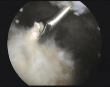 Arthroscopic view showing probe in subacromial space with white calcium material visible