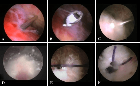 Six-panel arthroscopic sequence showing calcific tendinitis excision from needle puncture to calcium debridement and cuff repair