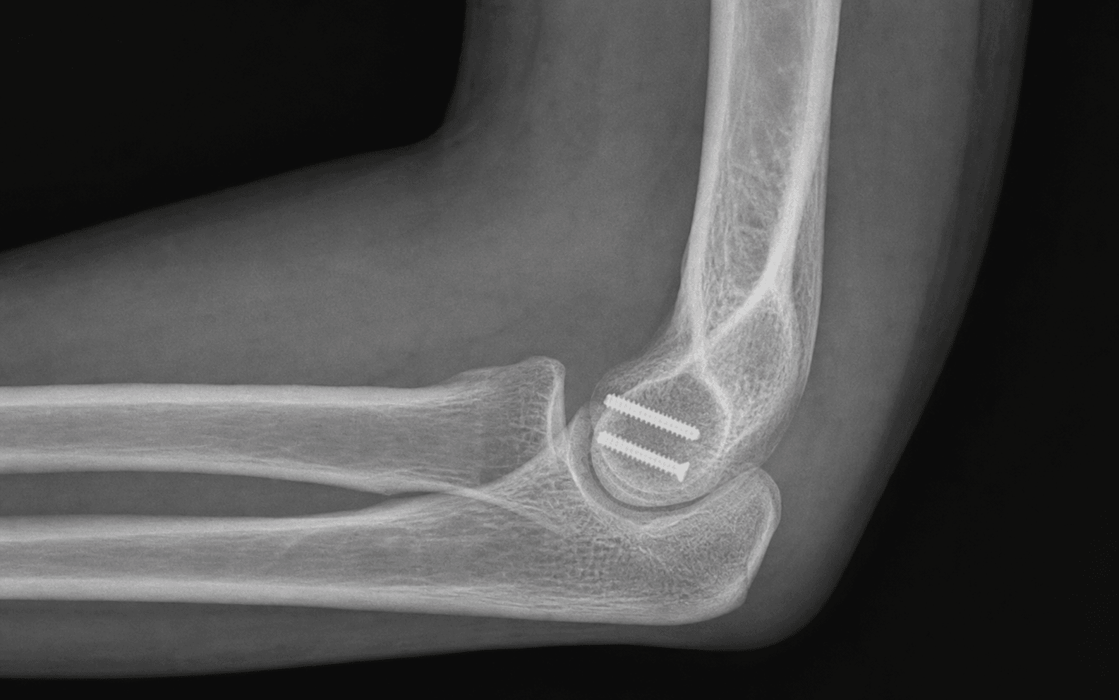 Capitellum coronal shear screw fixation