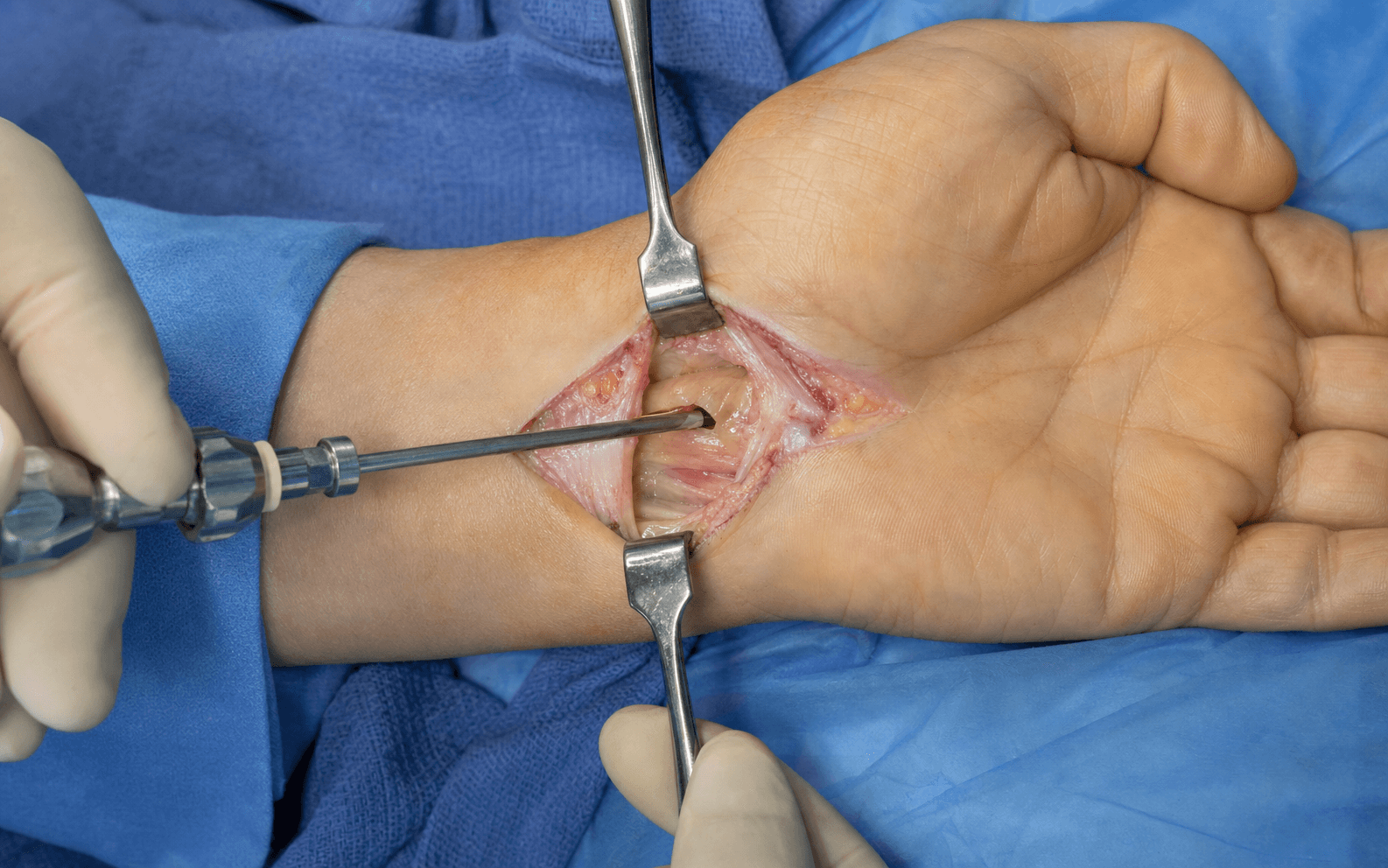 Single-portal endoscopic CTR