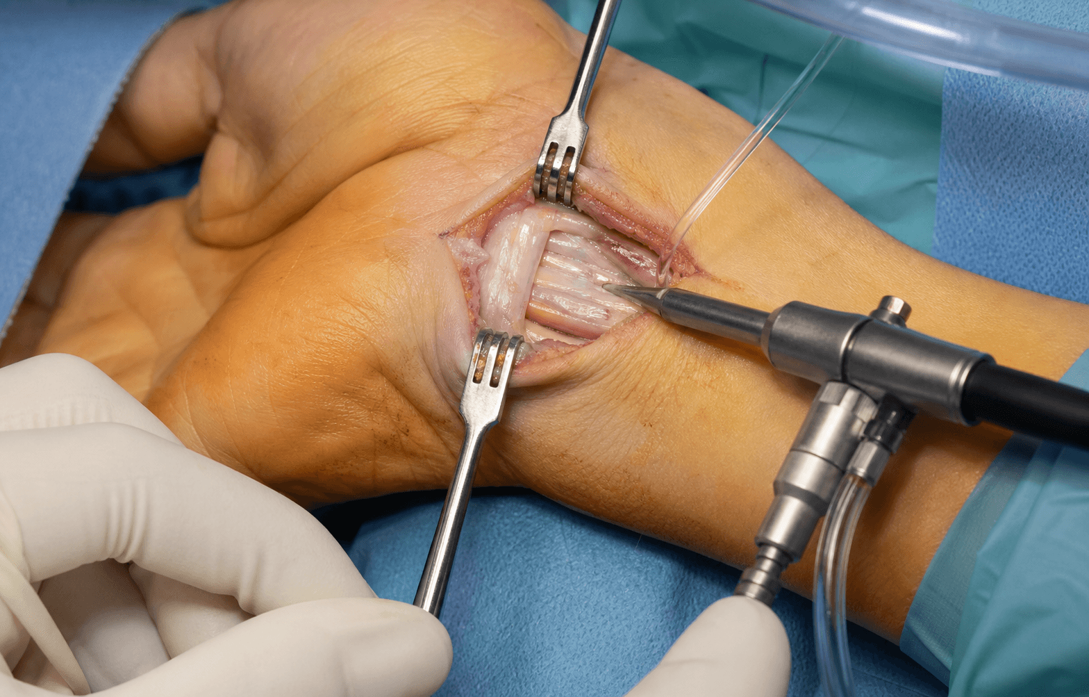 Carpal tunnel release